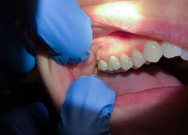 Best Chipped Tooth Repair Near Me  in Madelia, MN